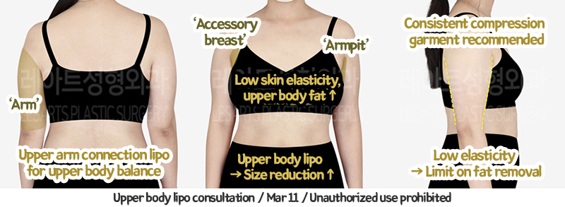 arm_liposuction_02_05_240117