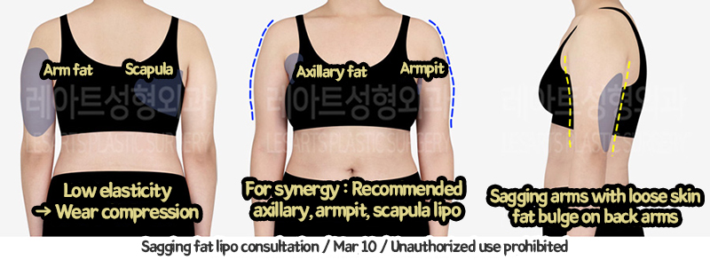 arm_liposuction_02_05_240129
