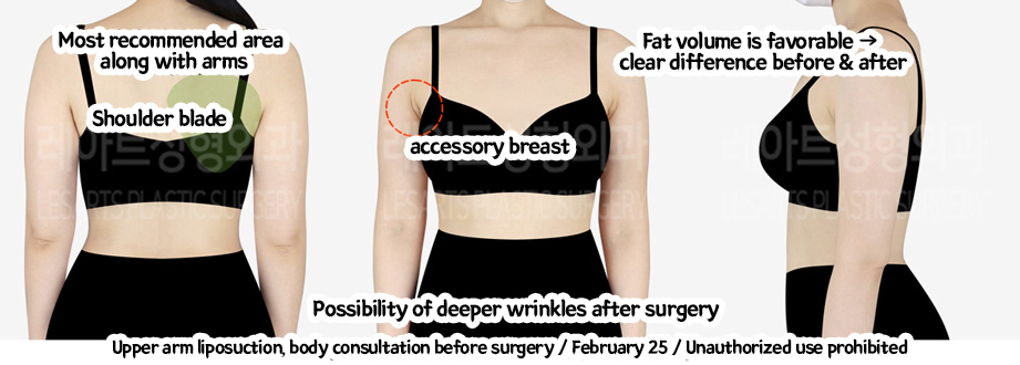arm_liposuction_02_05_240208
