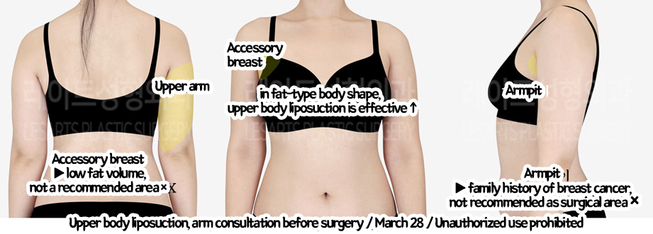 arm_liposuction_02_05_240219