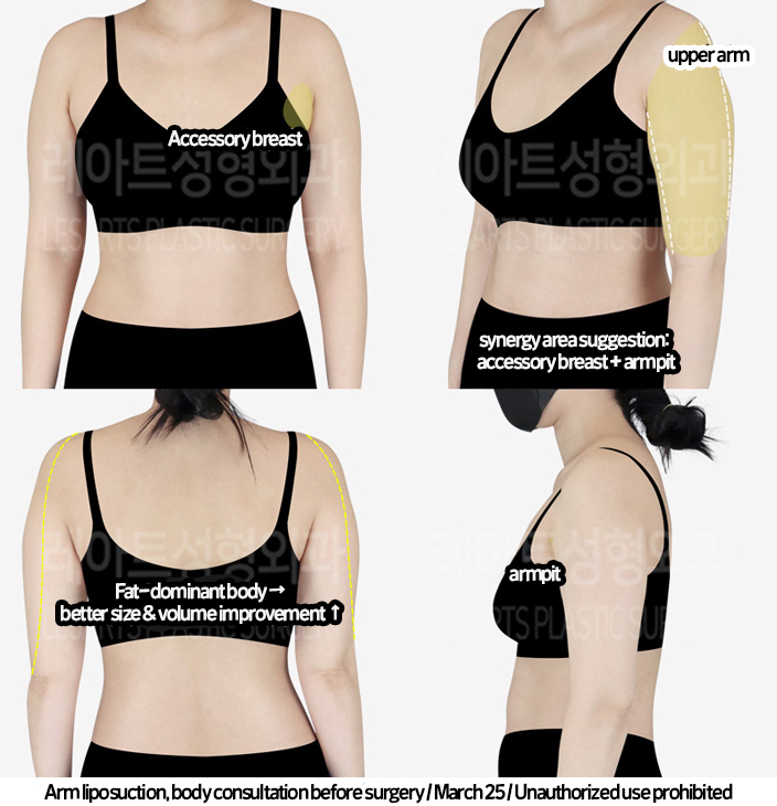 arm_liposuction_02_05_240219_2