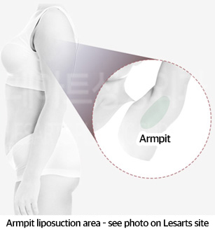 arm_liposuction_02_05_240223