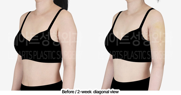 arm_liposuction_02_05_240229
