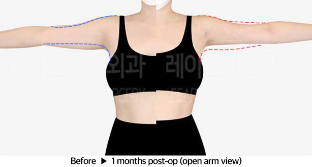 arm_liposuction_02_05_240326