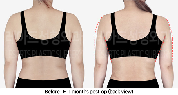 arm_liposuction_02_05_240401