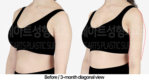 arm_liposuction_02_05_240422