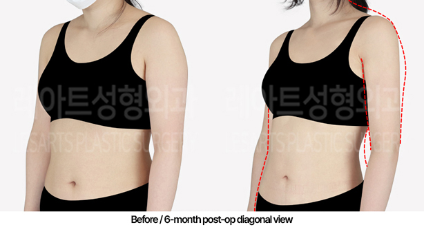 arm_liposuction_02_05_240509
