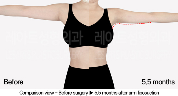 arm_liposuction_02_05_240520