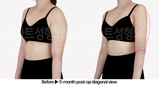 arm_liposuction_02_05_240527