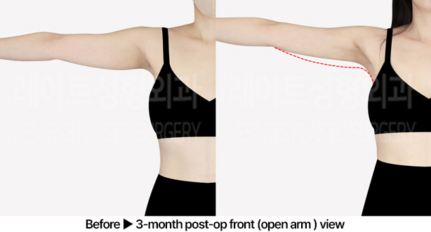 arm_liposuction_02_05_240531