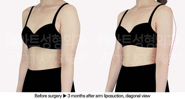 arm_liposuction_02_05_240611