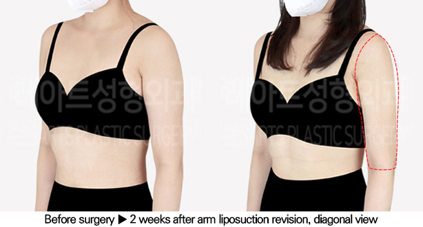 arm_liposuction_02_05_240625