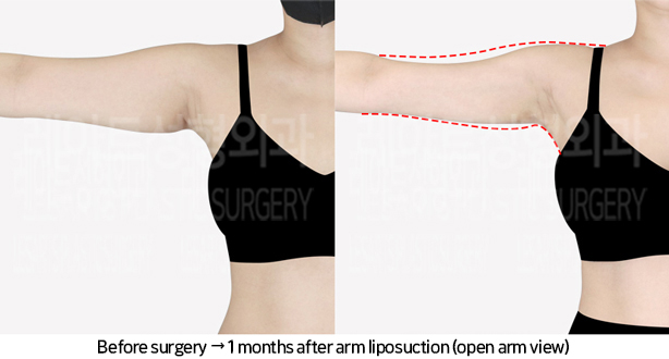arm_liposuction_02_05_240705