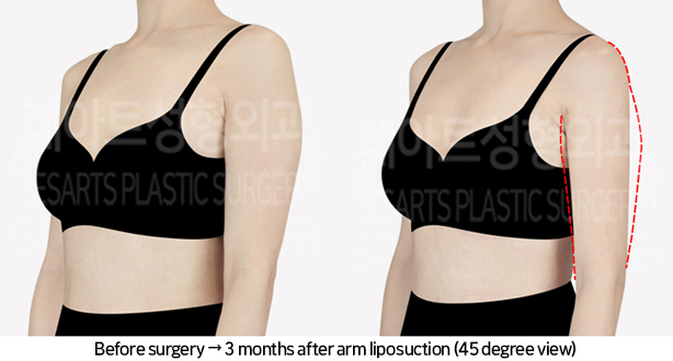 arm_liposuction_02_05_240709