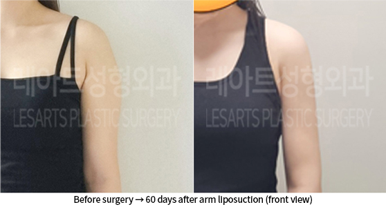 arm_liposuction_02_05_240723