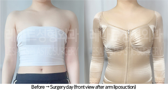 arm_liposuction_02_05_240725