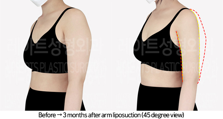 arm_liposuction_02_05_240729