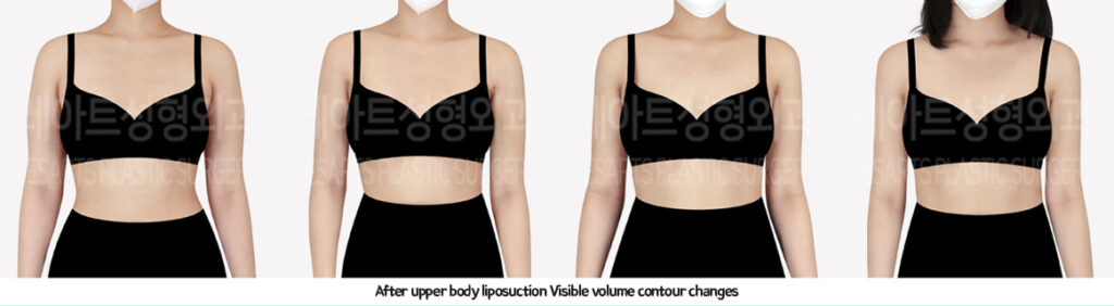 arm_liposuction_02_06_231226