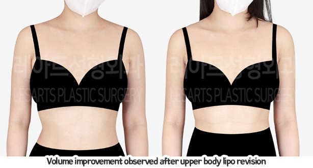arm_liposuction_02_06_240105