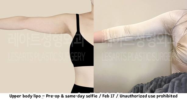 arm_liposuction_02_06_240111
