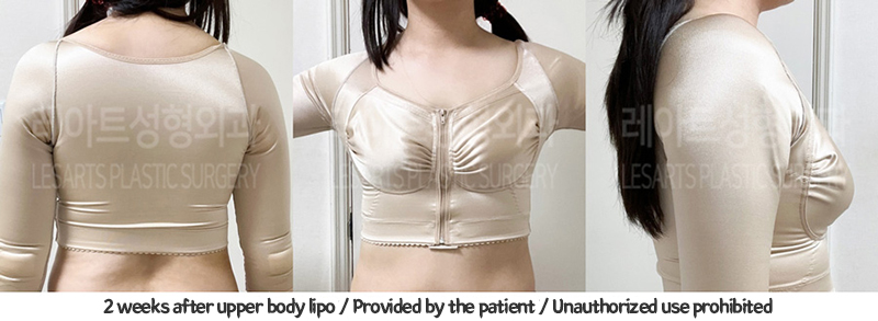 arm_liposuction_02_06_240117