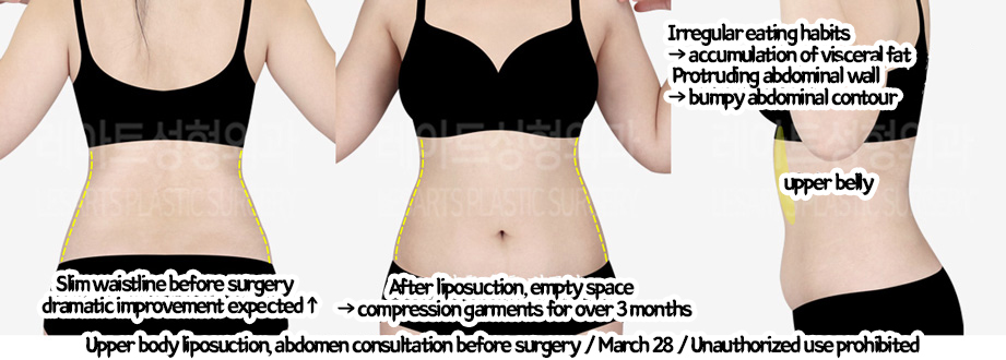 arm_liposuction_02_06_240219