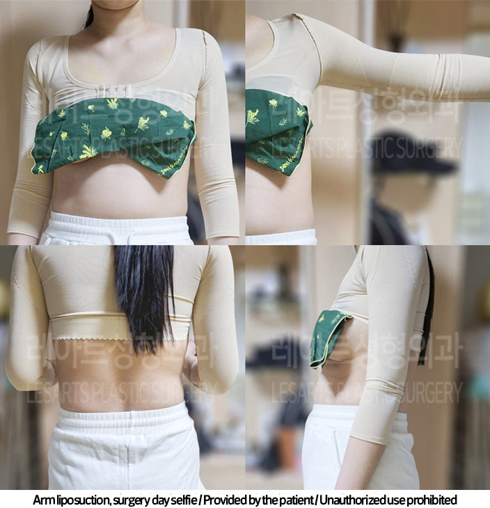 arm_liposuction_02_06_240219_2