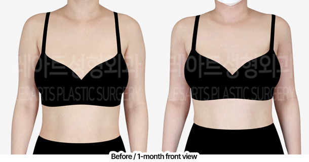arm_liposuction_02_06_240229