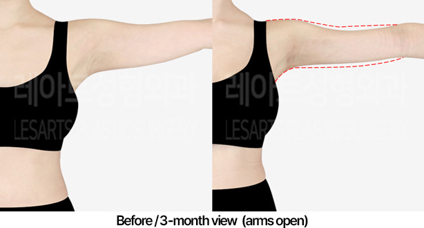 arm_liposuction_02_06_240422