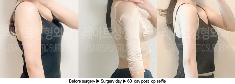 arm_liposuction_02_06_240625