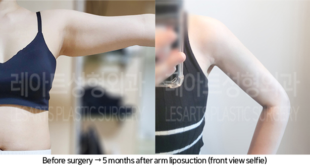 arm_liposuction_02_06_240705