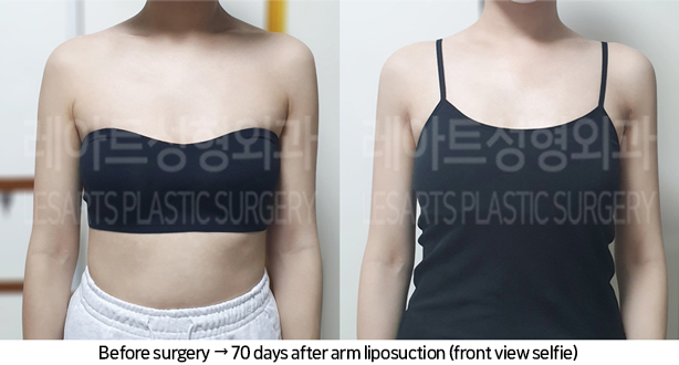 arm_liposuction_02_06_240709