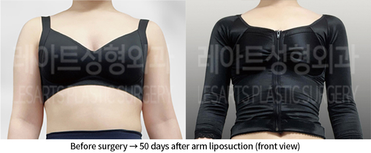 arm_liposuction_02_06_240712