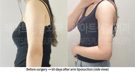 arm_liposuction_02_06_240723