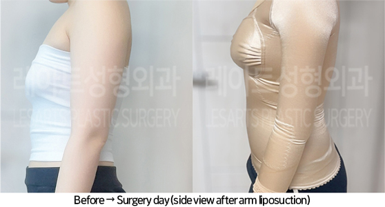 arm_liposuction_02_06_240725