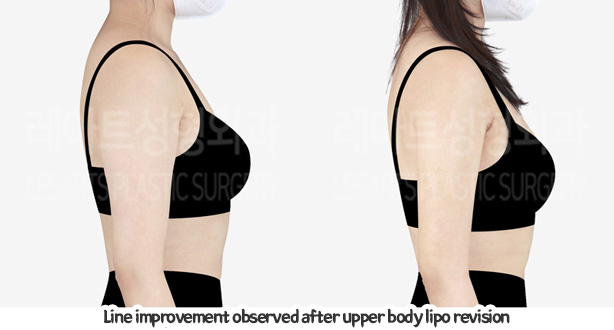 arm_liposuction_02_07_240105