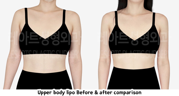 arm_liposuction_02_07_240111