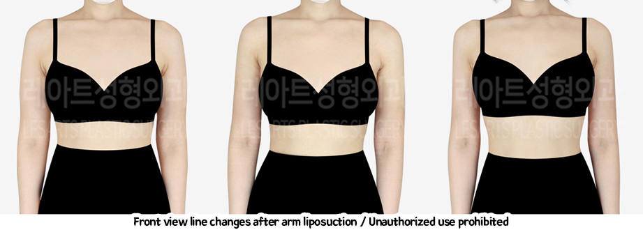 arm_liposuction_02_07_240208