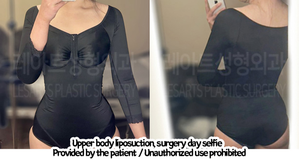 arm_liposuction_02_07_240219