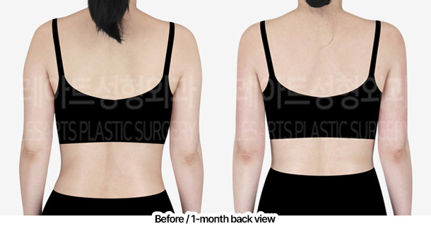 arm_liposuction_02_07_240229