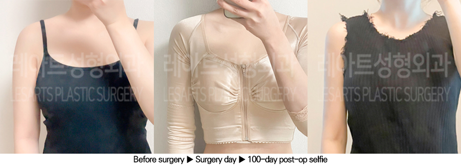 arm_liposuction_02_07_240625