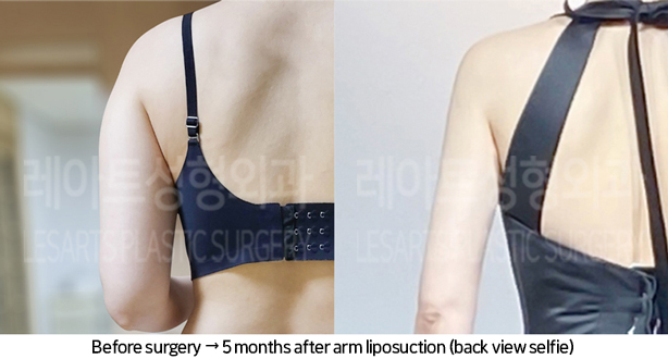 arm_liposuction_02_07_240705