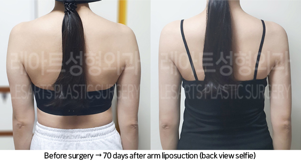 arm_liposuction_02_07_240709