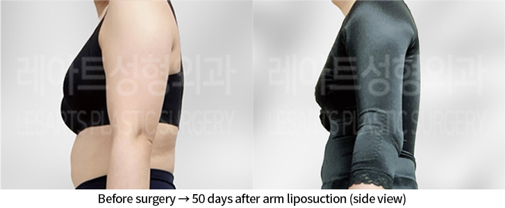 arm_liposuction_02_07_240712