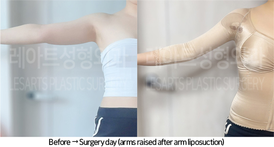 arm_liposuction_02_07_240725