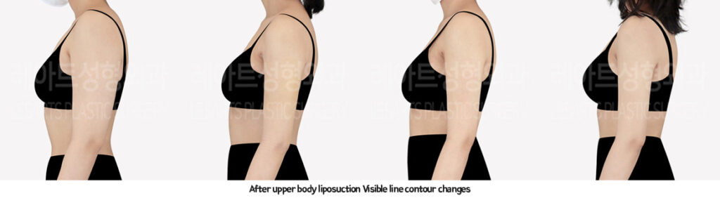 arm_liposuction_02_08_231226