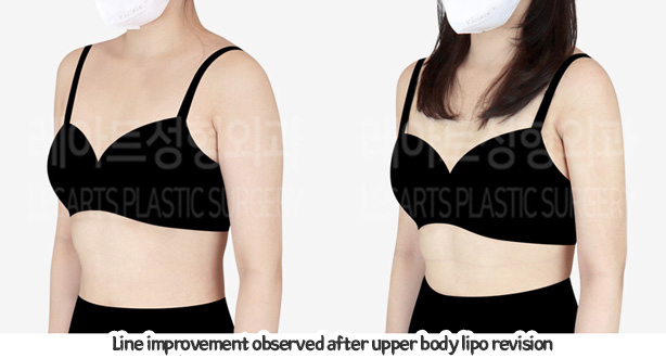 arm_liposuction_02_08_240105