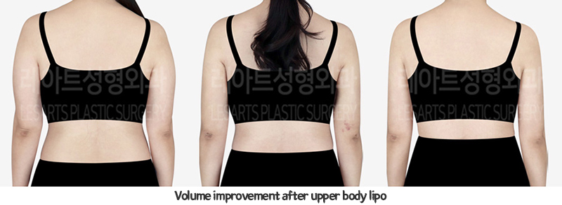 arm_liposuction_02_08_240117