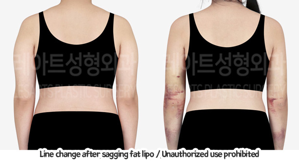 arm_liposuction_02_08_240129
