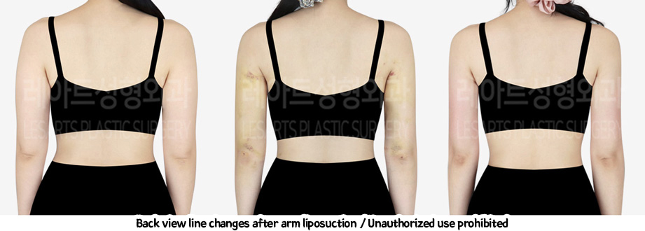arm_liposuction_02_08_240208